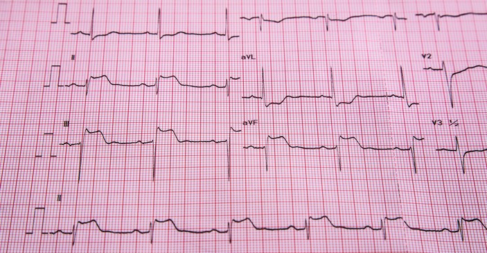 Objawy zawału mięśnia sercowego w EKG. Zdjęcie źródłowe: Getty Images EKG - STEMI - objawy uniesienia odcinka ST i zawał mięśnia sercowego