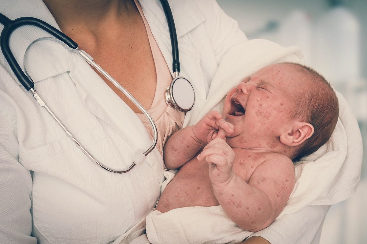 Różyczka w okresie niemowlęcym. Źródło: Getty Images Karmienie piersią z różyczką