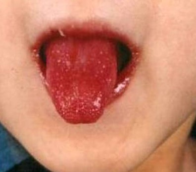 Malinowy język jako typowy objaw. Źródło zdjęcia: Getty Images Choroba Kawasaki - typowy malinowy język