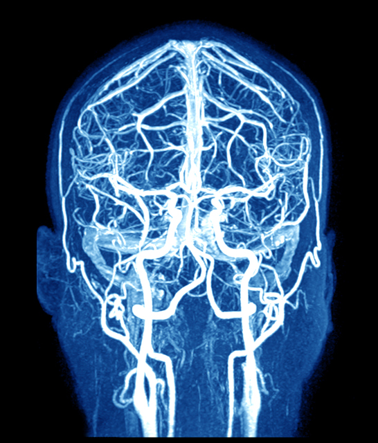 Rezonans magnetyczny mózgu. Źródło zdjęcia: Getty Images MRI mózgu i naczyń mózgowych