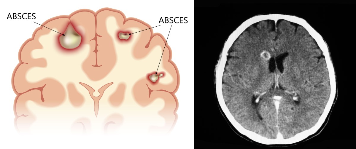 Anatomiczne i tomograficzne obrazy uszkodzenia mózgu Źródło: Getty Images Widoki anatomiczne i skany TK ropnia mózgu