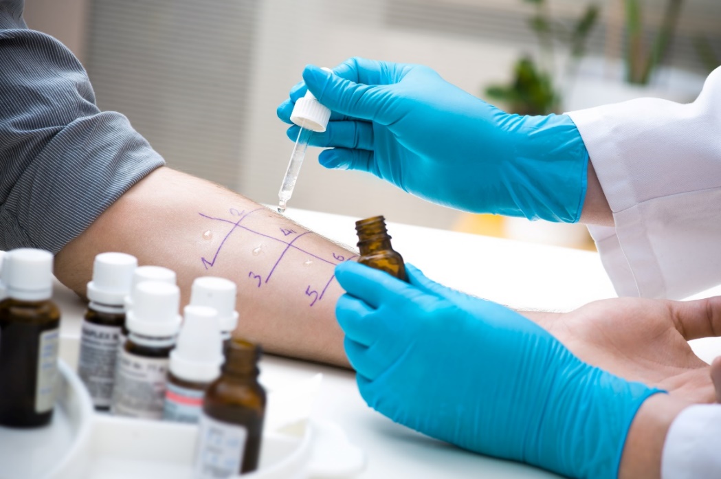 Diagnostyczny skórny test alergenowy. Źródło: Getty Images Diagnostyczny skórny test alergenowy