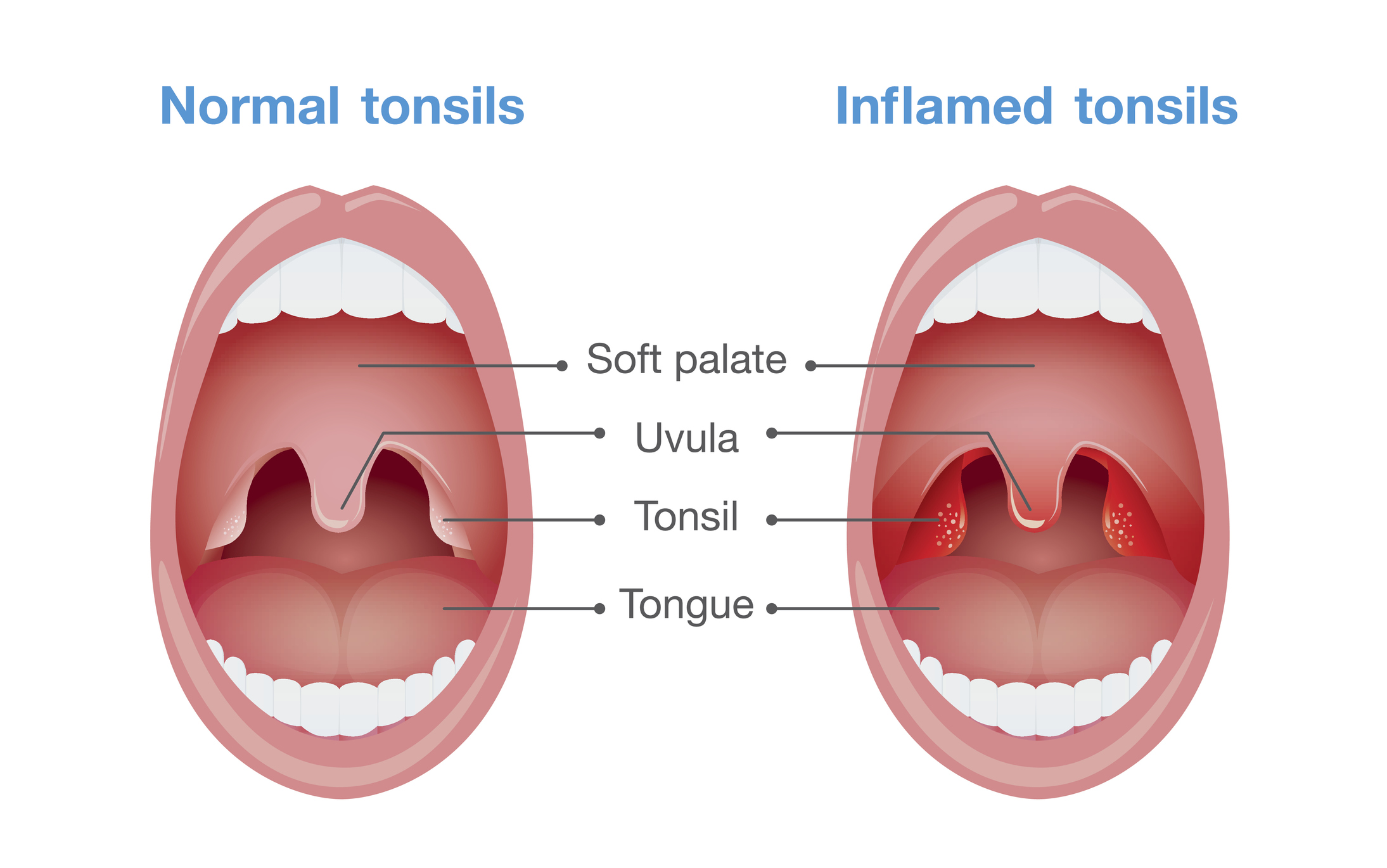 Angina - zapalenie migdałków