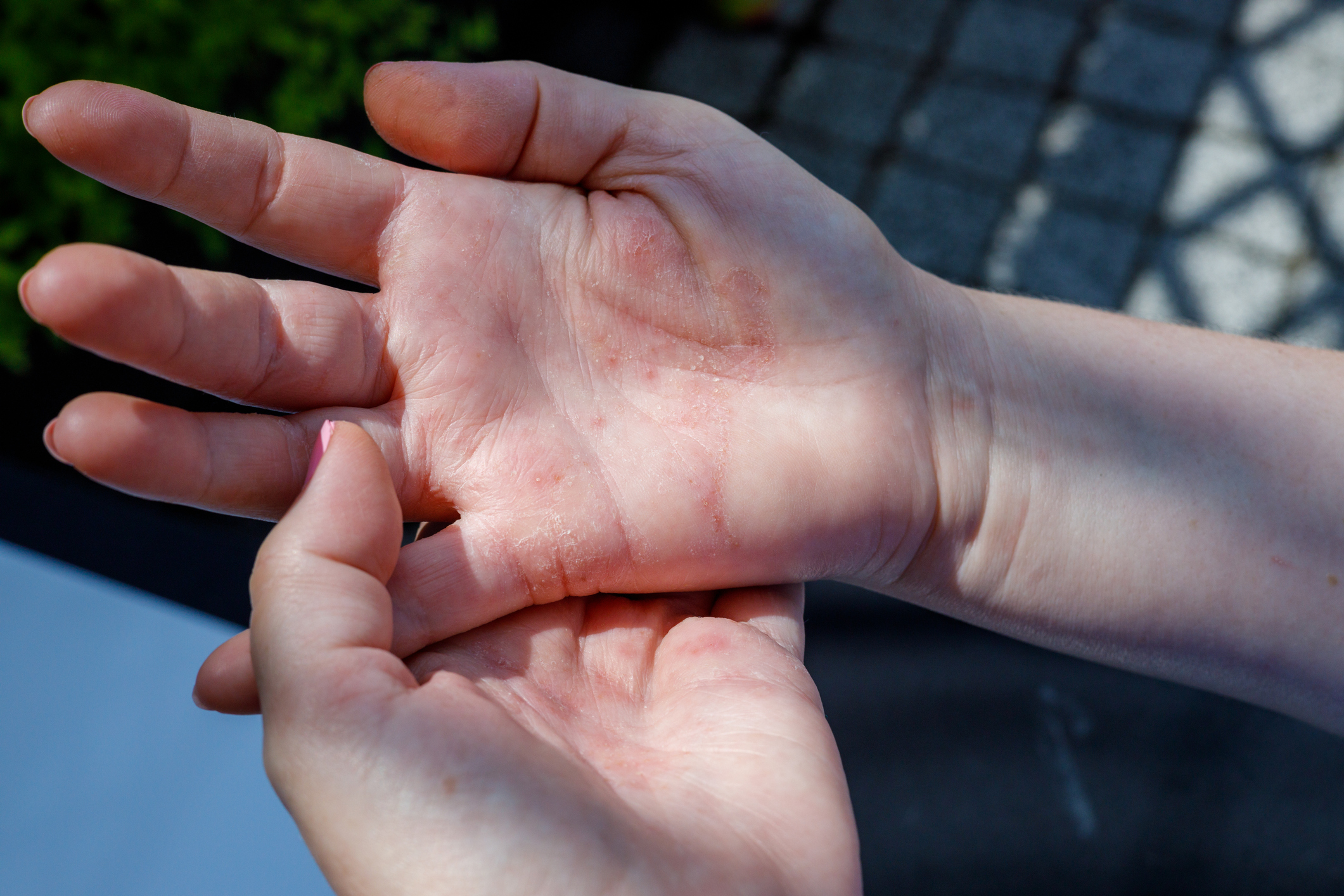 Wyprysk atopowy u dorosłych. Źródło: Getty Images Wyprysk atopowy u dorosłych