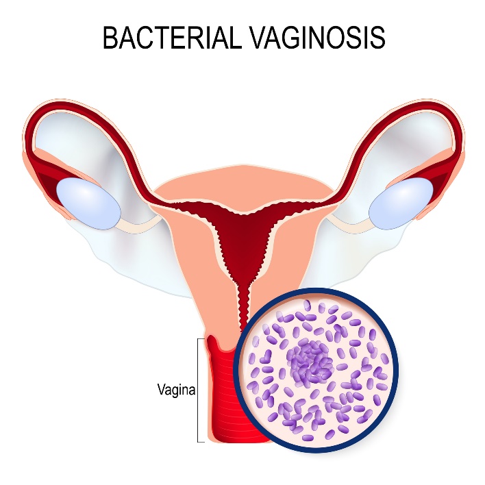 Bakteryjne zapalenie pochwy i przerost Gardnerella vaginalis. Źródło: Getty Images Bakteryjne zapalenie pochwy i przerost Gardnerella vaginalis