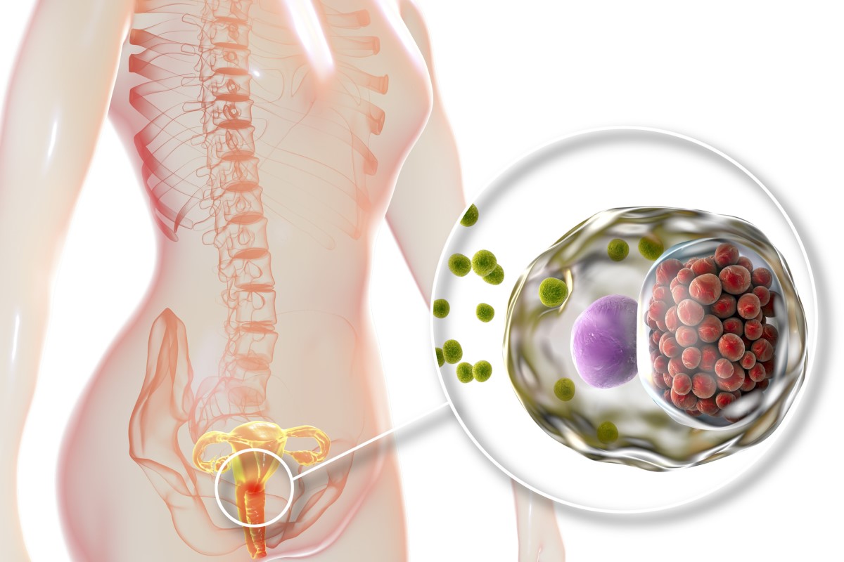 Pierwotne zakażenie szyjki macicy z późniejszym przeniesieniem na otaczający obszar. Źródło: Getty Images Infekcja zaatakowała szyjkę macicy - anatomiczną reprezentację żeńskiego układu rozrodczego.