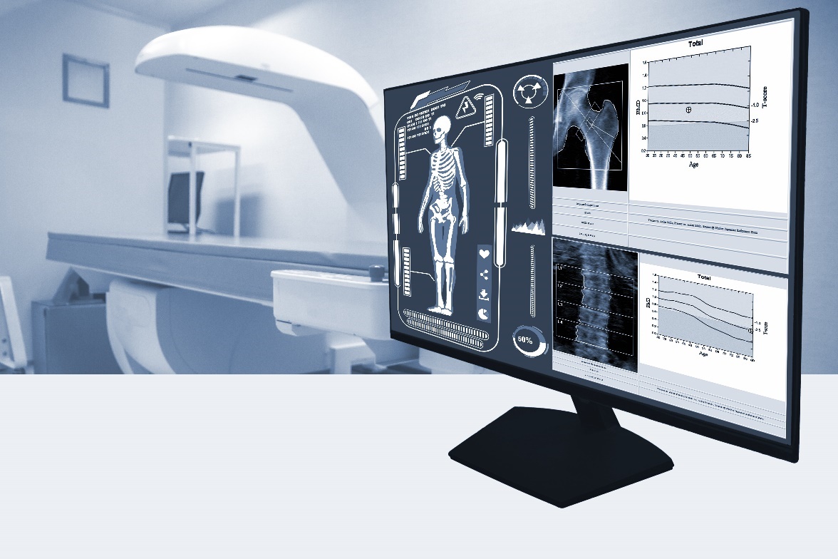 Złotym standardem w diagnostyce osteoporozy jest bezbolesne badanie densytometryczne z wykorzystaniem najnowszych metod obrazowania rentgenowskiego. Źródło: Getty Images Badanie densytometryczne