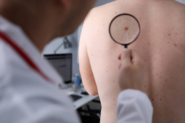 Dermatoskopia - badanie formacji skórnych