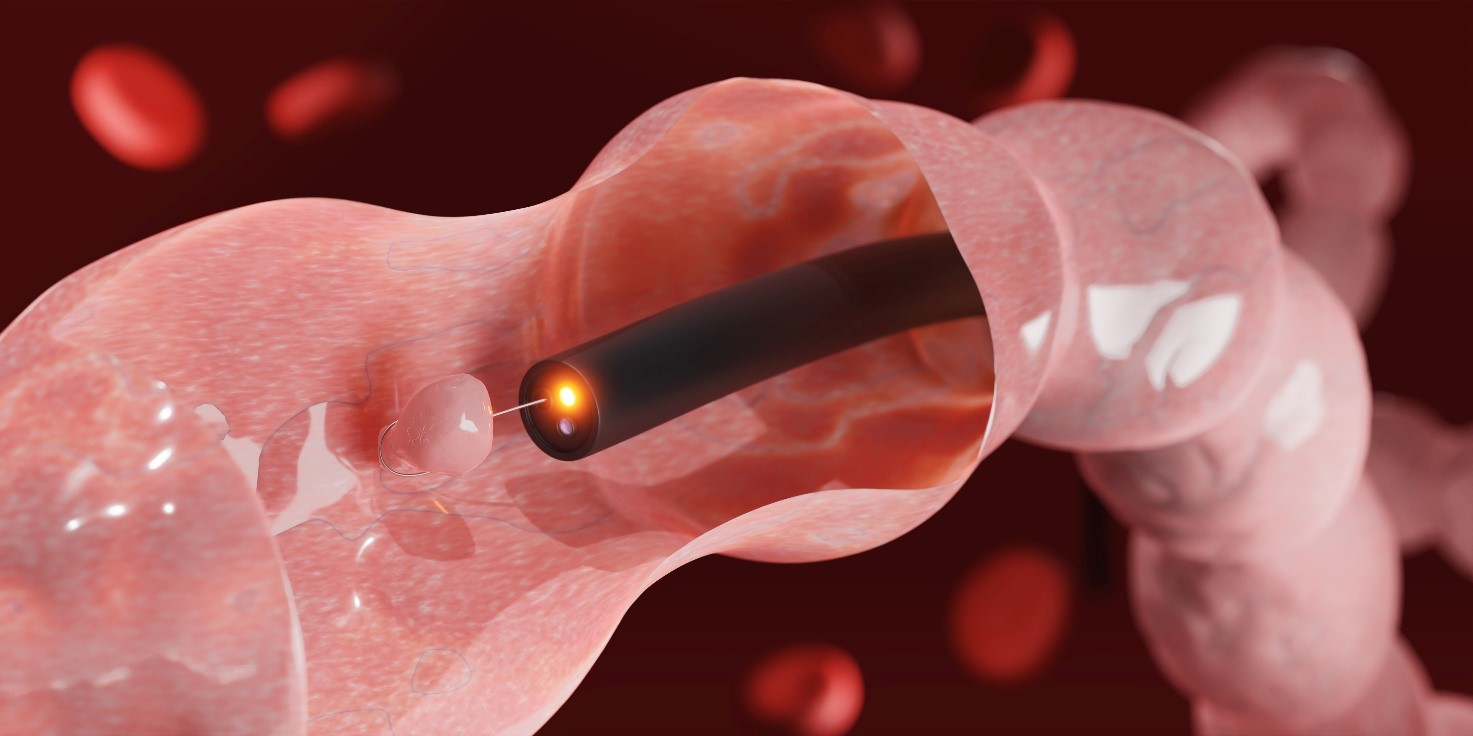 Kolonoskopia z biopsją - pobranie próbki polipa. Zdjęcie źródłowe: Getty Images Kolonoskopia i biopsja jelita grubego oraz pobieranie próbek polipów