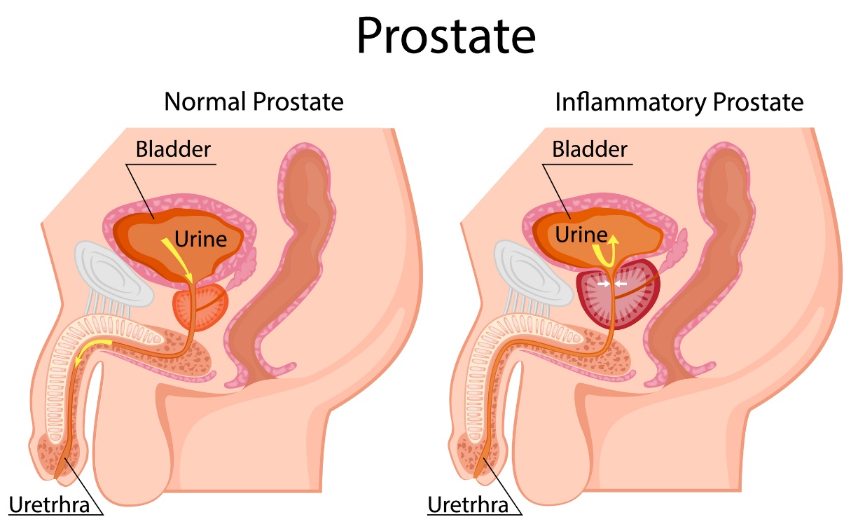 Po lewej: fizjologiczna prostata. Po prawej: powiększona prostata. Znajduje się poniżej pęcherza moczowego. Pęcherz moczowy (pęcherz), mocz, cewka moczowa. Źródło: Getty Images Po lewej: fizjologiczna prostata. Po prawej: powiększona prostata. Znajduje się poniżej pęcherza moczowego. Pęcherz moczowy, mocz, cewka moczowa.