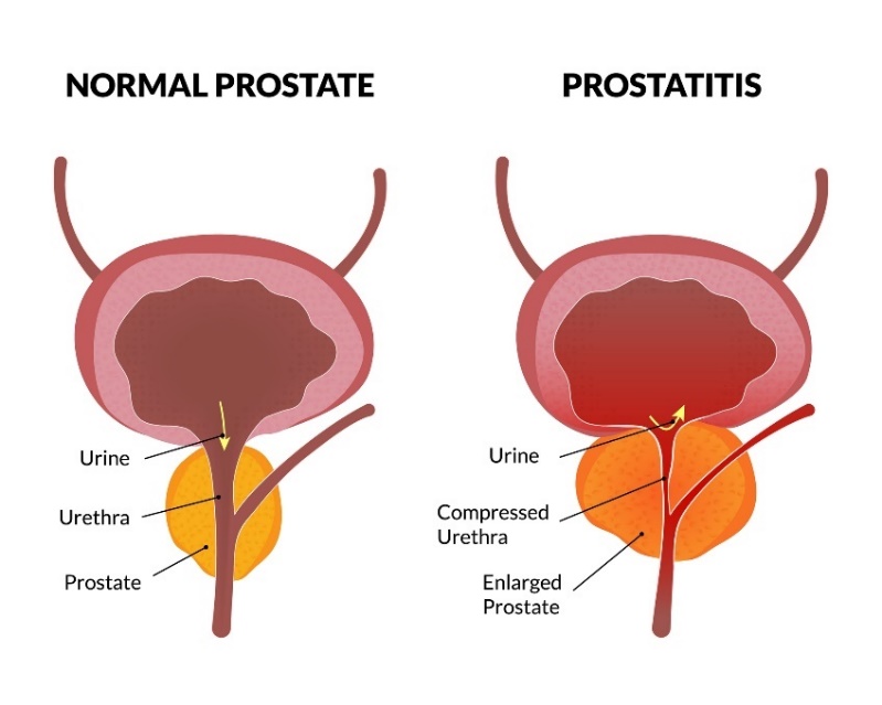 Fizjologia prostaty i zapalenie prostaty: mocz, cewka moczowa, prostata. Uciśnięta cewka moczowa, powiększona prostata. Źródło: Getty Images Stan fizjologiczny gruczołu krokowego i zapalenie gruczołu krokowego