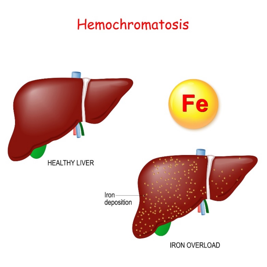 Hemochromatoza: fizjologia i patologia wątroby z nadmiernym odkładaniem żelaza (Fe)