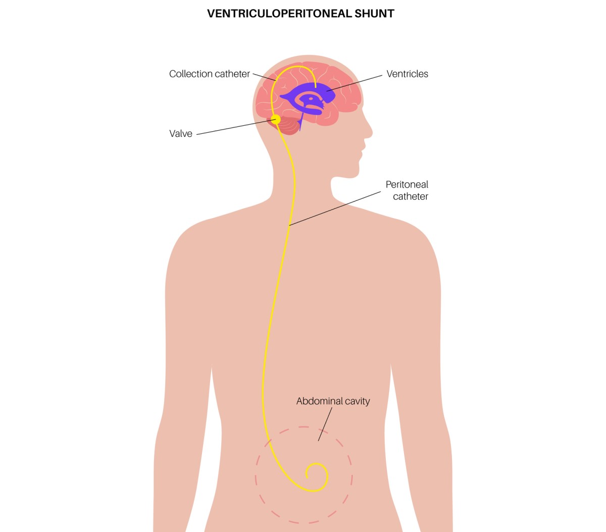 Przetoka z komór prowadzi do jamy brzusznej, gdzie odprowadza nadmiar płynu. Ventriculoperitoneal (przetoka komorowo-otrzewnowa, cewnik zbiorczy / zastawka / komory / cewnik otrzewnowy / jama brzuszna) Źródło: Getty Images Ilustracja zastawki komorowo-brzusznej, która odprowadza nadmiar płynu z mózgu do jamy brzusznej.