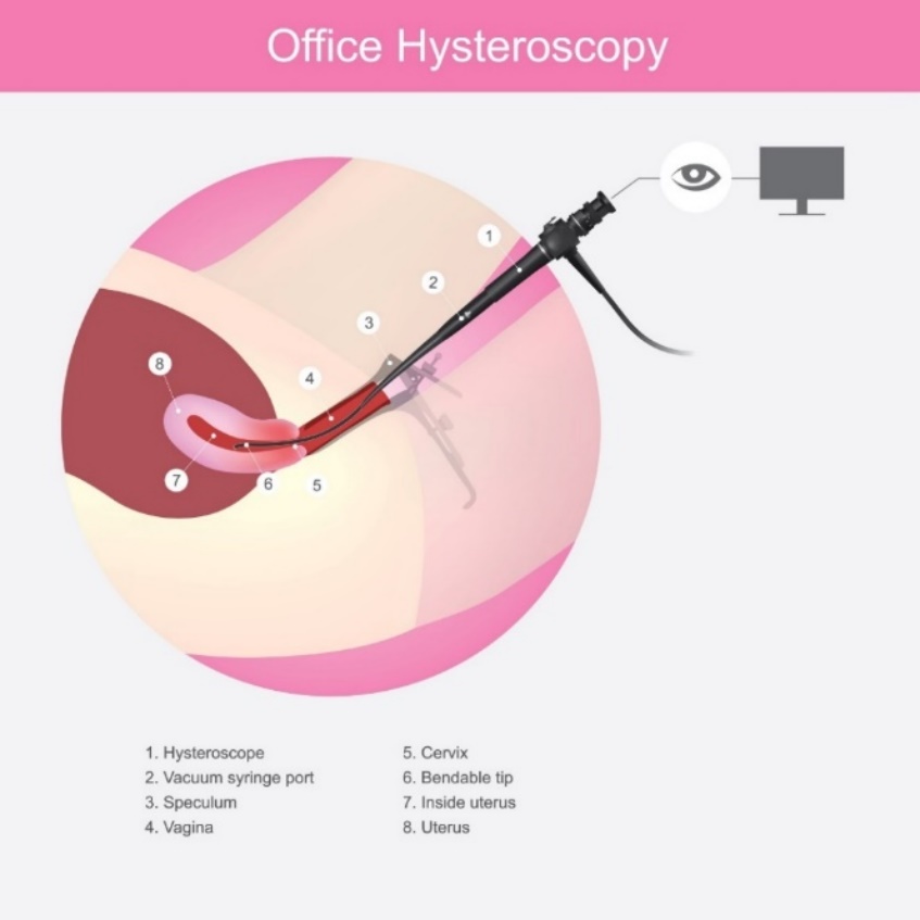 Histeroskopia: metoda diagnostyczna i chirurgiczna polipów macicy. 1 - histeroskop, 2 - port do strzykawki próżniowej, 3 - lusterko, 4 - osłona, 5 - szyjka macicy, 6 - giętka końcówka, 7 - wnętrze macicy, 8 - macica. Źródło: Getty Images Histeroskopia