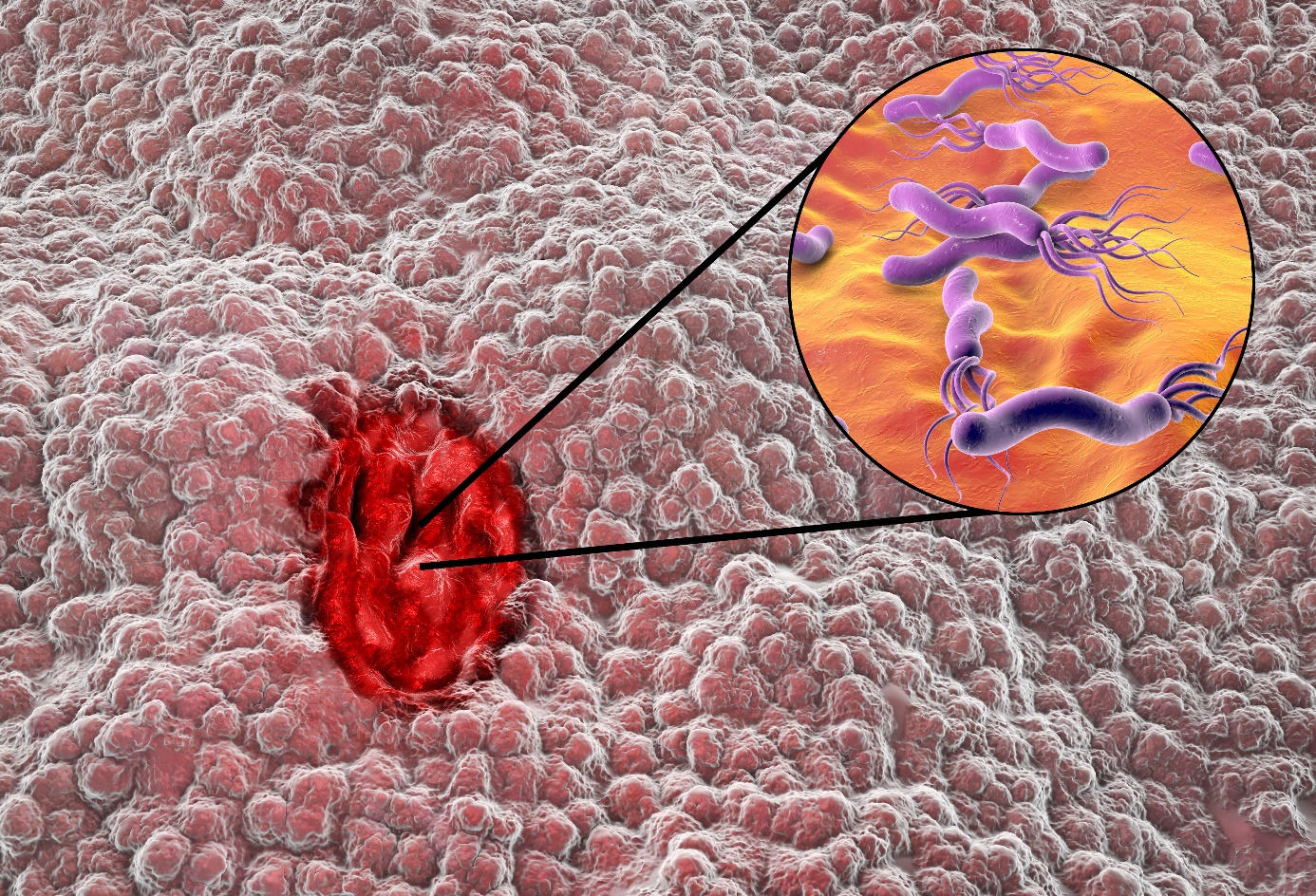 Zakażenie Helicobacter pylori Źródło: Getty Images Zakażenie Helicobacter pylori