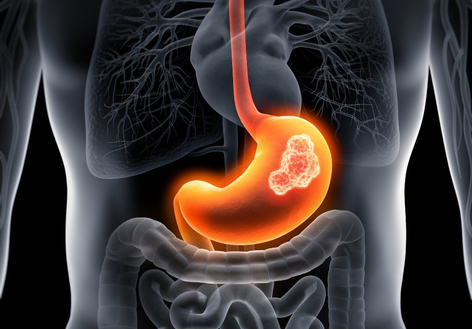 rak żołądka. Źródło: Getty Images Rak żołądka - model anatomiczny