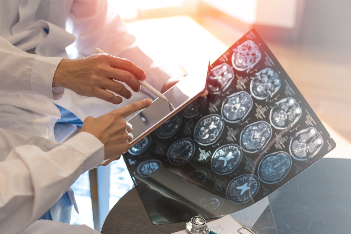 Zadaniem diagnozy jest również odróżnienie stwardnienia rozsianego od innej choroby, czyli diagnostyka różnicowa. Źródło: Getty Images Skan mózgu, jako podstawa badania, lekarz trzyma obrazy w jednej ręce, w drugiej trzyma tablet, ocenia stan.