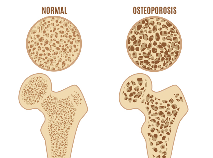 Osteoporoza kości udowej. Źródło: Getty Images Osteoporoza kości udowej