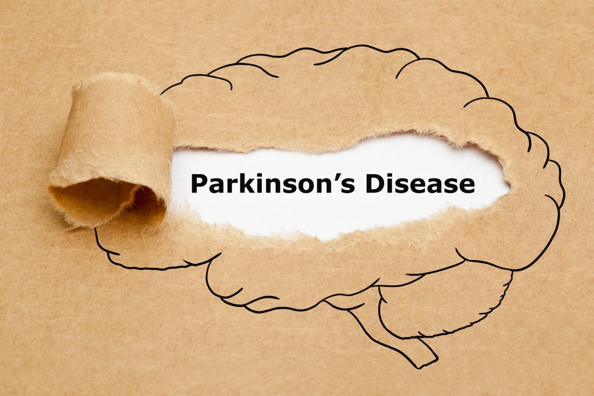 Morbus parkinson = choroba Parkinsona Źródło: Getty Images Morbus parkinson = choroba Parkinsona = choroba Parkinsona - animacja mózgu z chorobą Parkinsona w środku