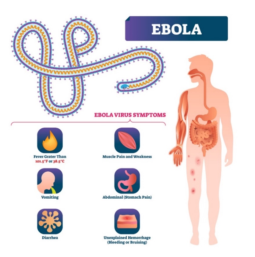 Objawy wirusa Ebola: wysoka gorączka (powyżej 38,5), wymioty, ból i osłabienie mięśni, ból brzucha, krwiak podskórny. Źródło: Getty Images Objawy wirusa Ebola
