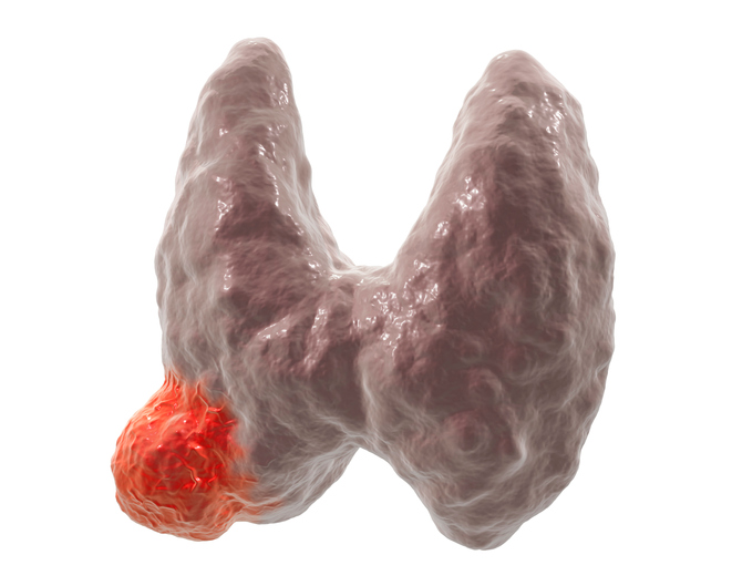 Rak tarczycy - źródło: Getty Images Rak tarczycy - obraz anatomiczny