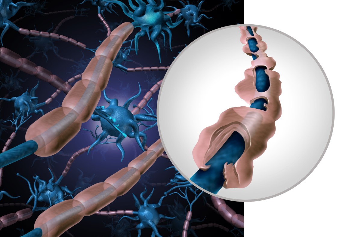 Ilustracja zdrowego i uszkodzonego neuronu - zdemielinizowanego włókna. Źródło: Getty Images Anatomiczna, obrazowa reprezentacja zdrowego i uszkodzonego neuronu - zdemielinizowane włókno