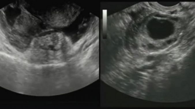 Sonografia w celu potwierdzenia diagnozy. Źródło: Getty Images USG - ultrasonografia jamy brzusznej - obraz podczas badania, obrazowanie macicy i ciąży pozamacicznej