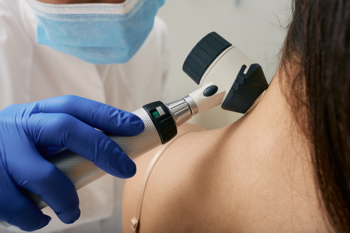 Badanie medyczne formacji skórnych za pomocą dermatoskopu. Źródło: Getty Images Badanie medyczne formacji skórnych za pomocą dermaskopu