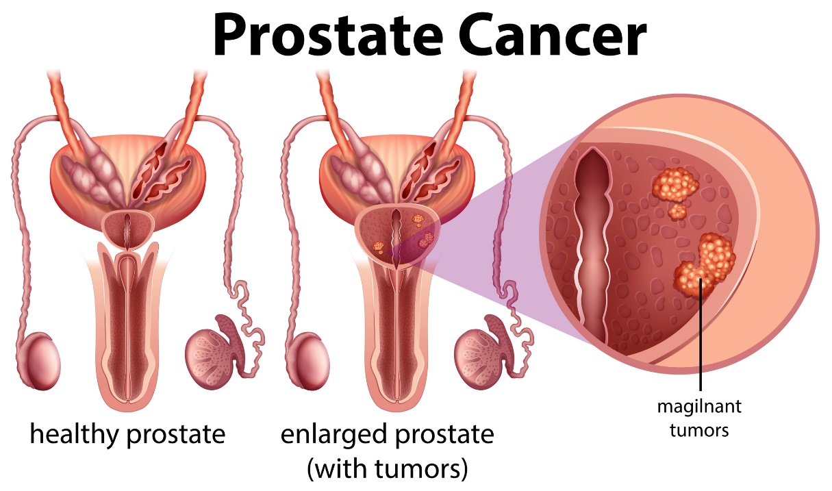 Rak prostaty. Zdrowa prostata i powiększona prostata z guzem. Źródło zdjęcia: Getty Images Rak prostaty - zdrowa prostata i powiększona prostata z guzem