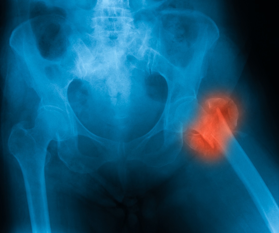 Złamanie szyjki kości udowej jest najbardziej krytycznym złamaniem osteoporotycznym. Źródło: Getty Images Złamanie szyjki kości udowej