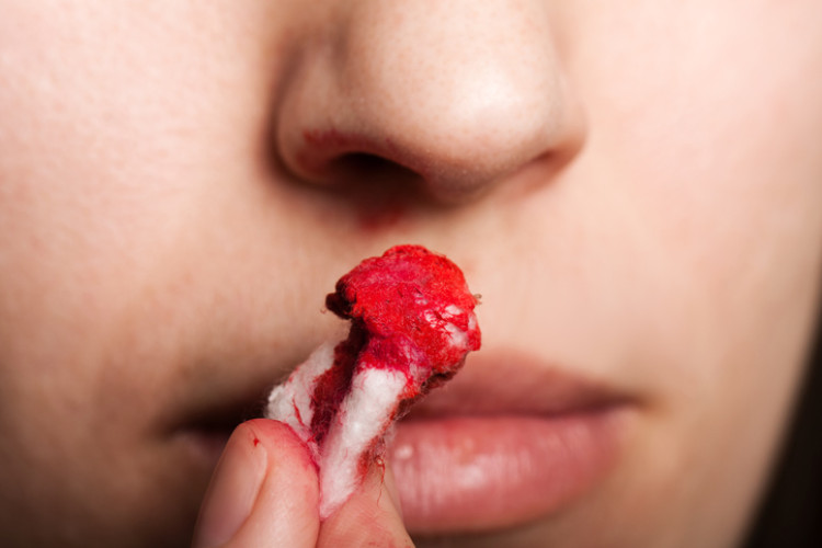 Tampon nasiąknięty krwią Źródło zdjęcia: Getty Images kobieta trzymająca zakrwawiony tampon przy nosie