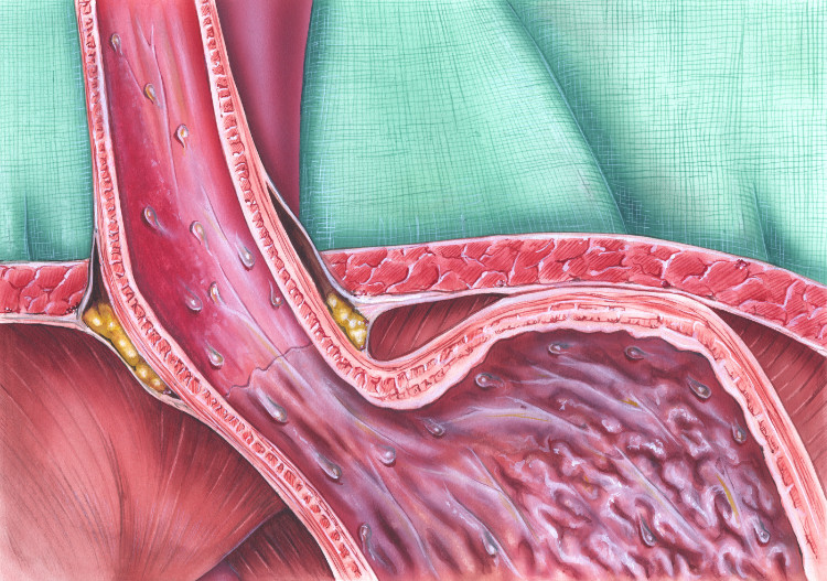 Zwieracz przełyku (przejście do żołądka). Źródło: Getty Images anatomicznie przedstawiony zwieracz przełyku