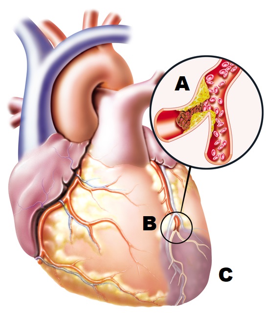 anatomiczny rysunek serca z zablokowanym naczyniem krwionośnym