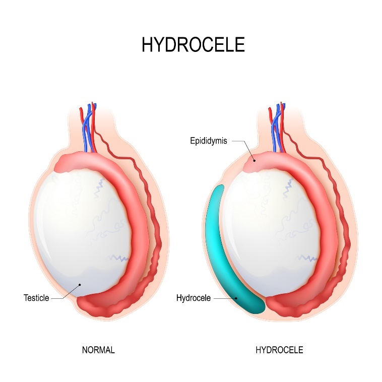 Hydrocele: Testicle (jądro), Epididymis (najądrze), Hydrocele (nagromadzony płyn). Źródło: Getty Images Wodniak: jądro, najądrze, wodniak (nagromadzony płyn)