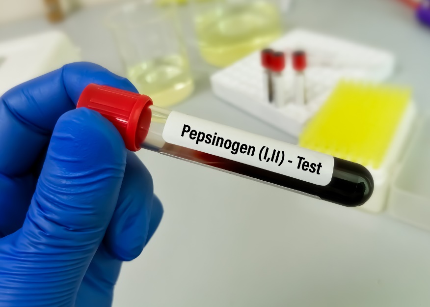 Próbka krwi do badań laboratoryjnych poziomu pepsynogenu i chorób żołądka. Źródło: Getty Images Próbka krwi do badań laboratoryjnych poziomów pepsynogenu i chorób żołądka i jelit
