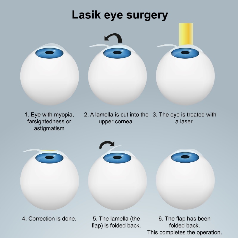 Laserowa chirurgia oka LASIK - metoda podpowierzchniowa. Procedura z płatkiem bez uszkodzenia zakończeń nerwowych.