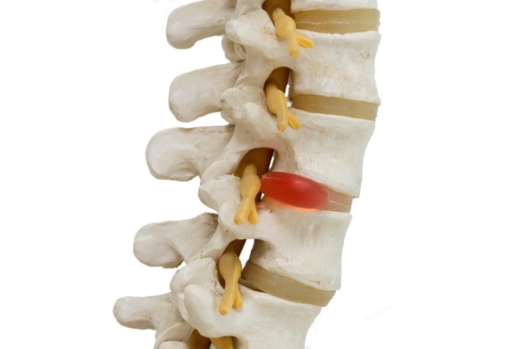 Jedną z możliwych przyczyn bólu kręgosłupa jest ucisk nerwu przez przepuklinę dysku. Źródło: Getty Images Anatomiczne przedstawienie modelu 3D kręgosłupa, krążków międzykręgowych i przepukliny dysku z uciskiem nerwu