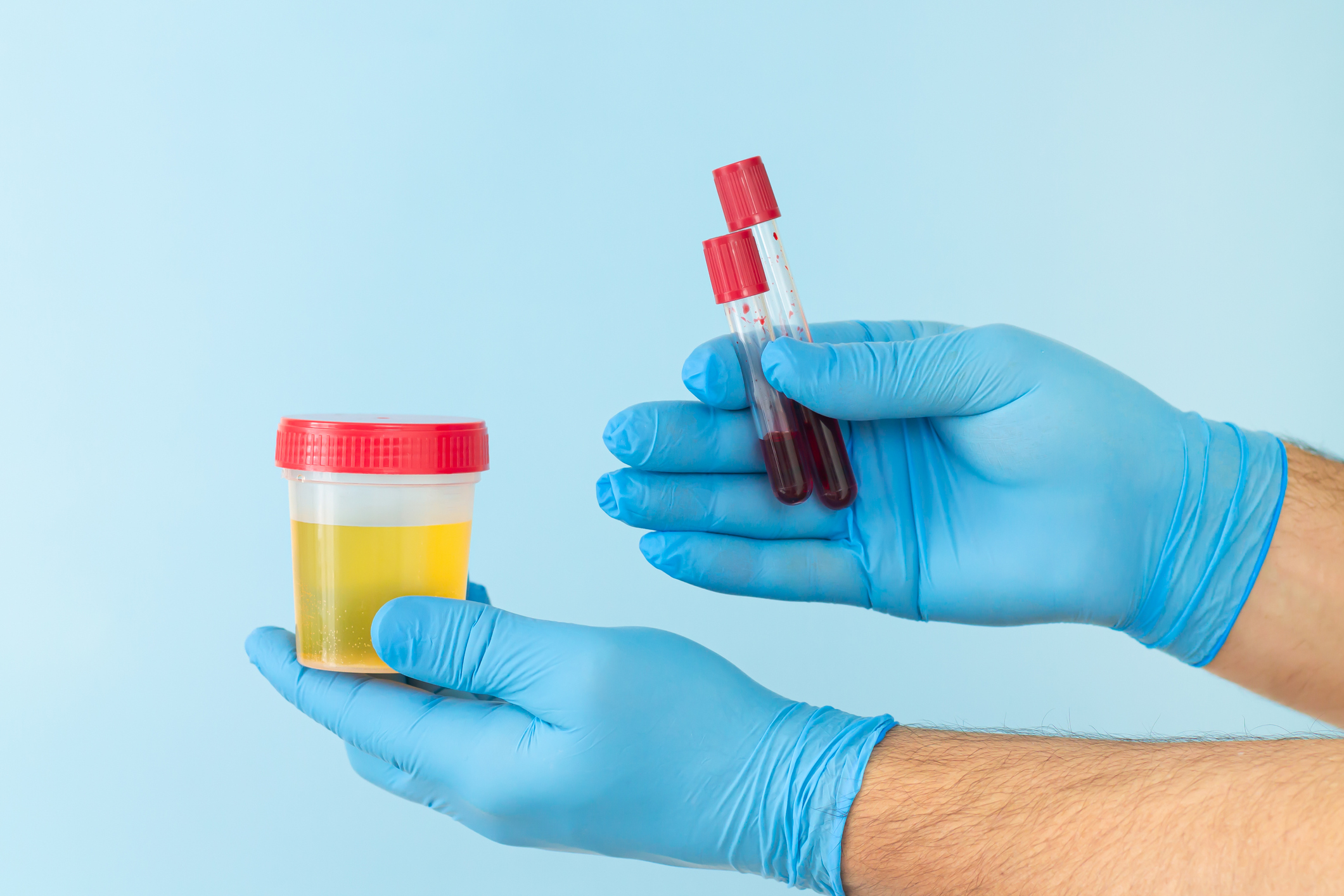 Odchylenia od fizjologicznego poziomu chlorków we krwi lub moczu są wykrywane za pomocą testów laboratoryjnych. Źródło: Getty Images Odchylenia od fizjologicznego poziomu chlorków we krwi lub moczu są wykrywane za pomocą testów laboratoryjnych.