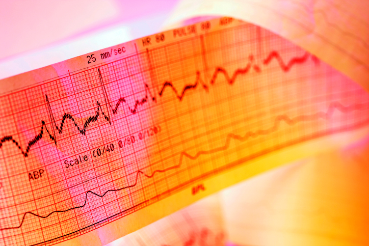 Zapis EKG