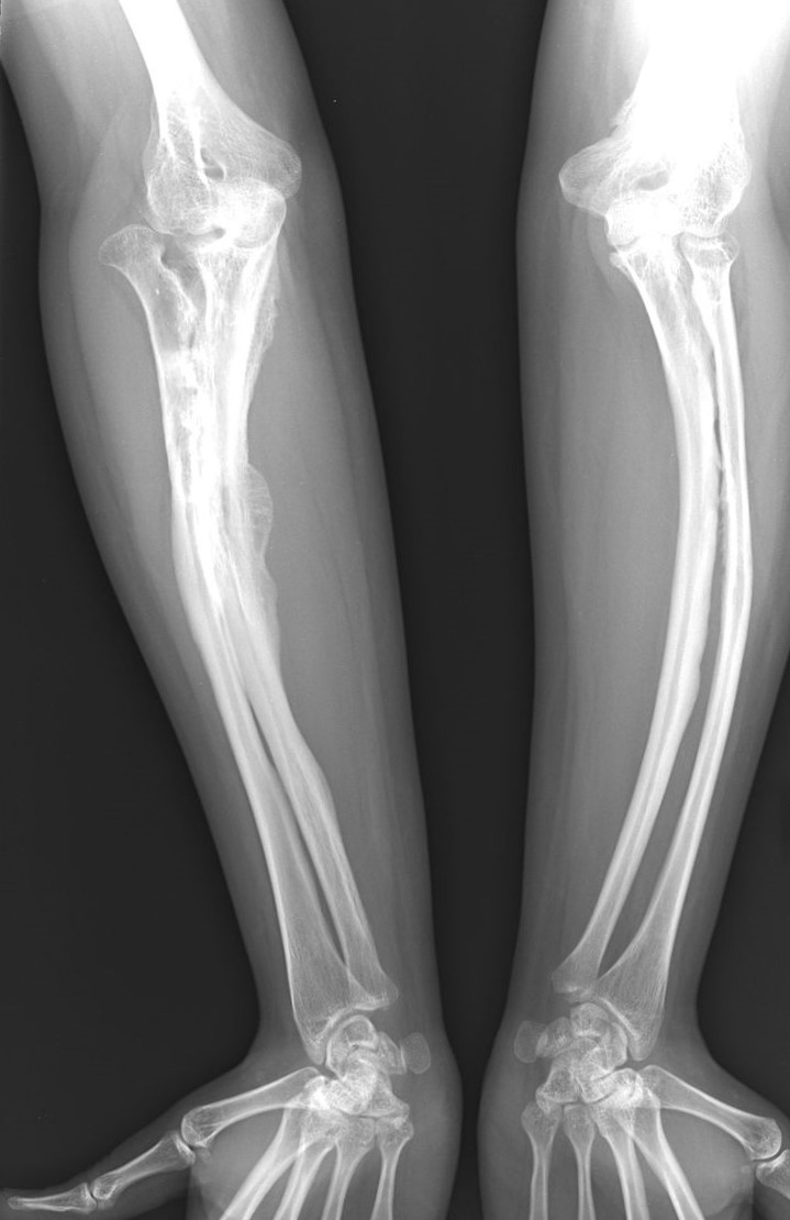 Osteogenesis imperfecta u osoby dorosłej Autor zdjęcia: ShakataGaNai Radiogramy choroby osteogenesis imperfecta u osoby dorosłej