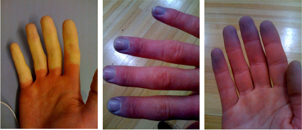 Przebarwienia dłoni w zespole Raynauda, sinica akralna
