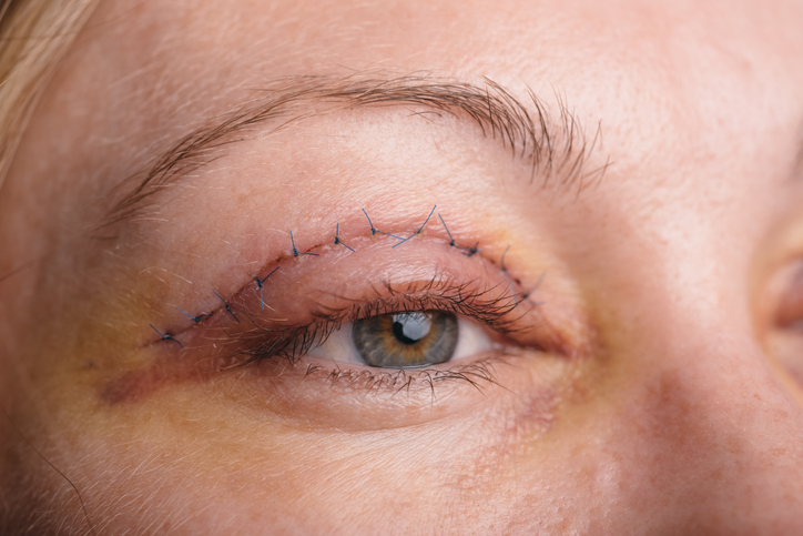Blepharoplastyka powieki górnej Źródło zdjęcia: Getty Images Kobieta, twarz i powieka po blepharoplastyce - blepharoplastyka
