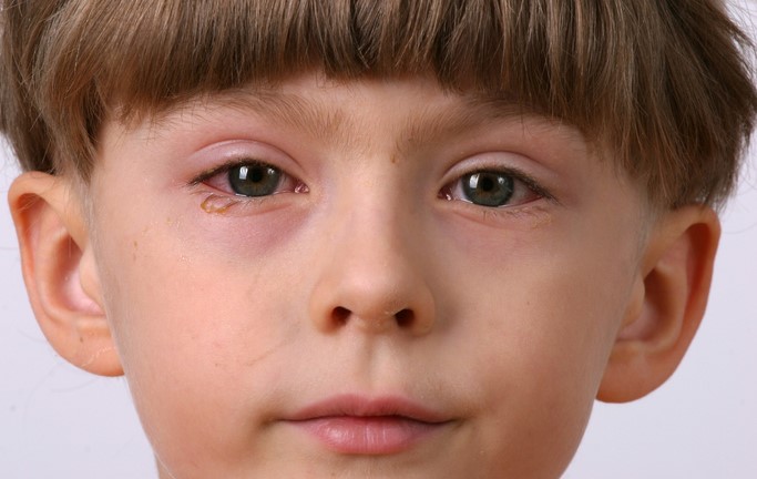 Objawy są powiązane z przyczyną wyzwalającą, na przykład stanem zapalnym. Źródło zdjęcia: Getty Images Dziecko ma zaognione oko, czerwone i opuchnięte.