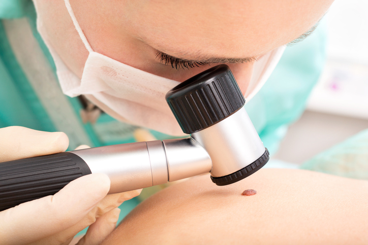 Lekarz obserwuje znamiona za pomocą dermatoskopu. Zdjęcie źródłowe: Getty Images lekarz bada znamię skórne za pomocą dermatoskopu
