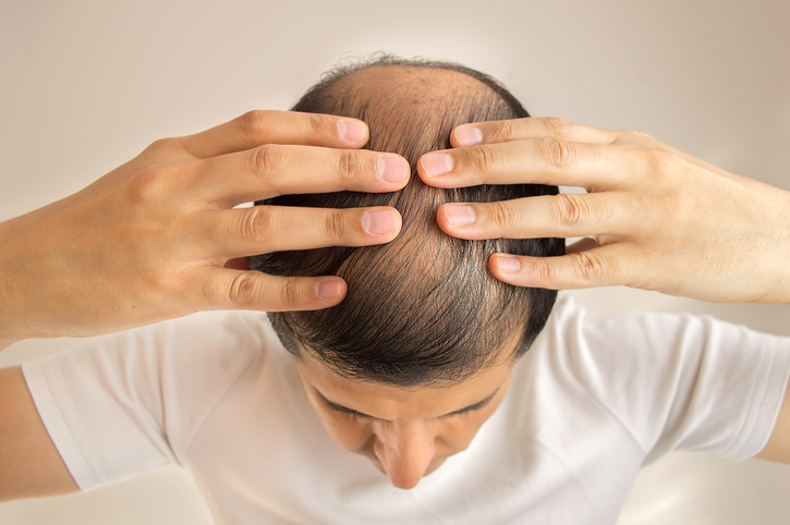 Alopecie. Zdjęcie: Thinkstock photos Mężczyzna z rzadkimi włosami, wypadaniem włosów, łysiną lub łysieniem, ręce na głowie, widok z góry