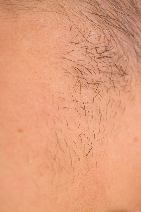 Niektóre leki lub narkotyki mogą powodować problemy, ale także nadmierny stres. Zdjęcie: Thinkstock photos Skóra, włosy łonowe, utrata włosów łonowych, rzadkie włosy łonowe