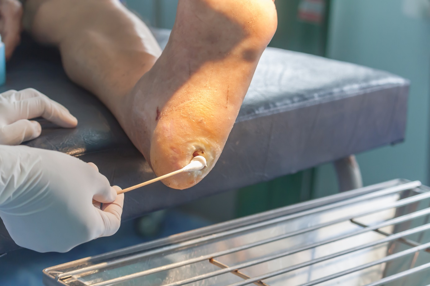 Sanitariat - leczenie owrzodzenia nogi Źródło: Getty Images Higiena - leczenie owrzodzenia kości piszczelowej za pomocą tamponu i rąk opiekuna