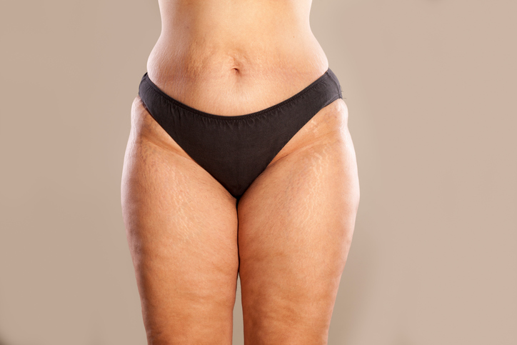Pojawienie się cellulitu jest uwarunkowane kilkoma czynnikami ryzyka. Zdjęcie źródłowe: Getty Images Cellulit, uda, kobieta