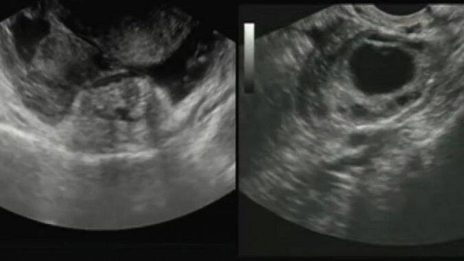 USG jamy brzusznej jest ważne dla potwierdzenia diagnozy. Źródło: Getty Images
