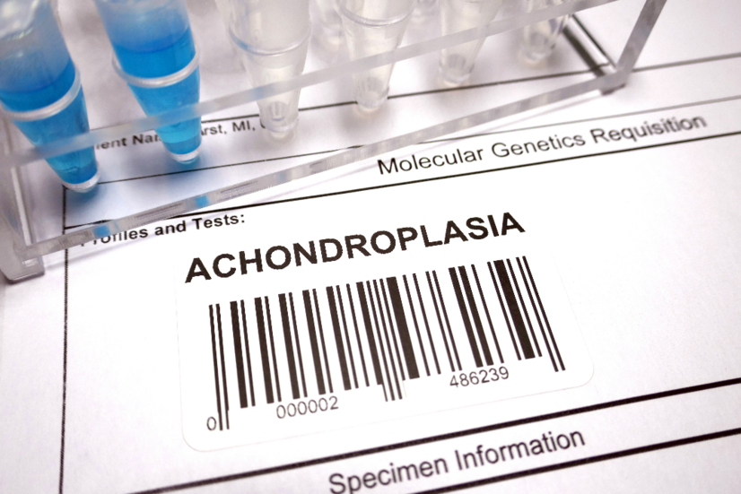 Achondroplazja: Jakie są przyczyny i objawy wrodzonej choroby kości?